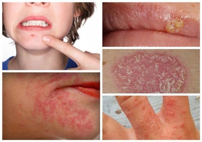 Alergi dan penyakit kulit adalah tanda parasit dalam tubuh