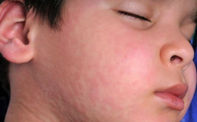 Ruam alergi pada kulit - gejala adanya cacing parasit di dalam tubuh
