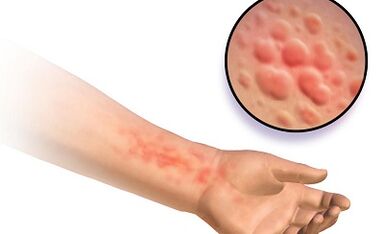 Manifestasi schistosomosis pada manusia